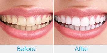 Whitening Kit Sonic Toothbrush